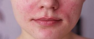 Allergic rash on face
