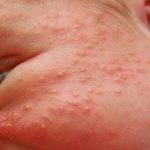 allergic rash in children photo