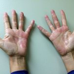 allergic dermatitis on hands photo
