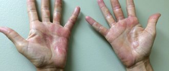 аллергический дерматит на руках фото