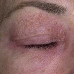 Allergic dermatitis of the eyelids