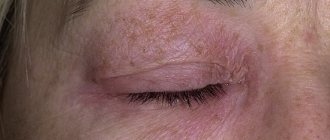 Allergic dermatitis of the eyelids