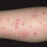 аллергия на руках и ногах