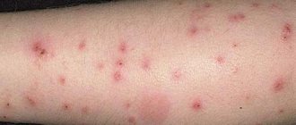 аллергия на руках и ногах