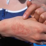 Allergy on hands