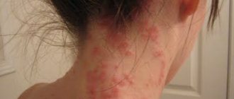 аллергия на шампунь симптомы фото