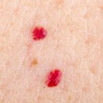 Angiomas on the body in women. Causes, treatment and removal 