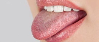 White growths on the tongue: causes, possible diseases, treatment methods, reviews