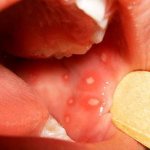 White pimples in a child&#39;s mouth