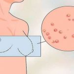 White spots on the nipples may indicate hormonal imbalance
