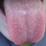white coating on the tongue, red bumps appeared photo