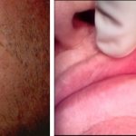White growth on lip 2