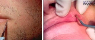 White growth on lip 2