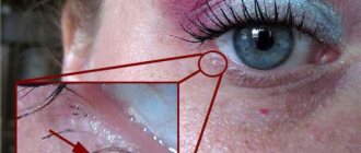 white pimple on the eyelid