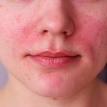 Facial skin disease