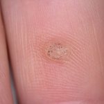 The wart on the finger became inflamed