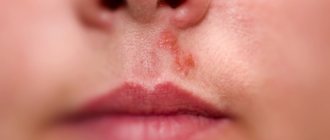 We quickly treat rashes near the nose