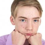 How to treat teenage acne in boys to get rid of acne forever?