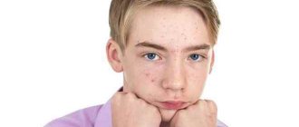 How to treat teenage acne in boys to get rid of acne forever?
