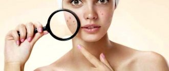 What are age spots?