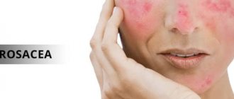 What is Rosacea