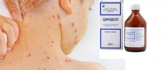 Tsindol for chickenpox in children
