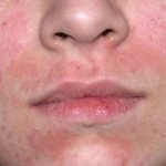 Demodicosis on the skin of the face
