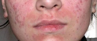 Demodicosis on the skin of the face