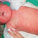 dermatitis in a child