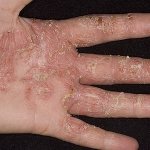 Dyshidrosis of the hands