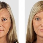 Before and after using hyaluronic acid injections