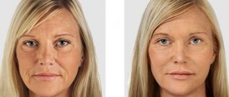 Before and after using hyaluronic acid injections