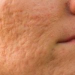Effective treatments for post-acne