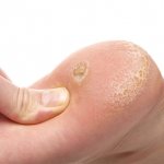 If it was not possible to prevent the appearance of a callus, then you need to get rid of it immediately.