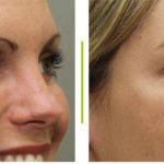 before and after photos of botox for eyes