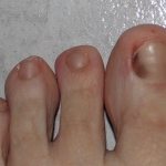 Photo of nail melanoma