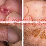 Photos of genital warts
