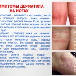 Фотографии симптомов дерматита ног и его лечение у взрослых