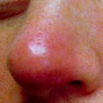 Furuncle on the nose: causes and treatment at home with folk remedies