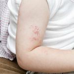 Herpes in children occurs as often as in adults, its primary form is most typical