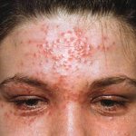 Eczema herpetiformis on the face