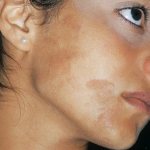Skin hyperpigmentation