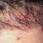 Pustules on the head in the hair and hair loss