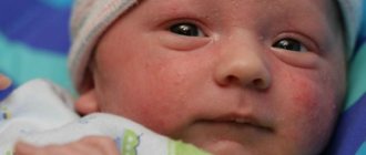 Pustules on the face of a newborn