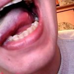 Abscess on the tongue