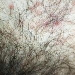 Purulent acne on the pubis
