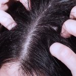 Scalp fungus: symptoms, treatment and prevention Photo 1