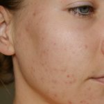 How to get rid of acne spots quickly