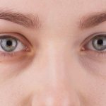 How to get rid of blue bags under eyes