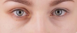 How to get rid of blue bags under eyes